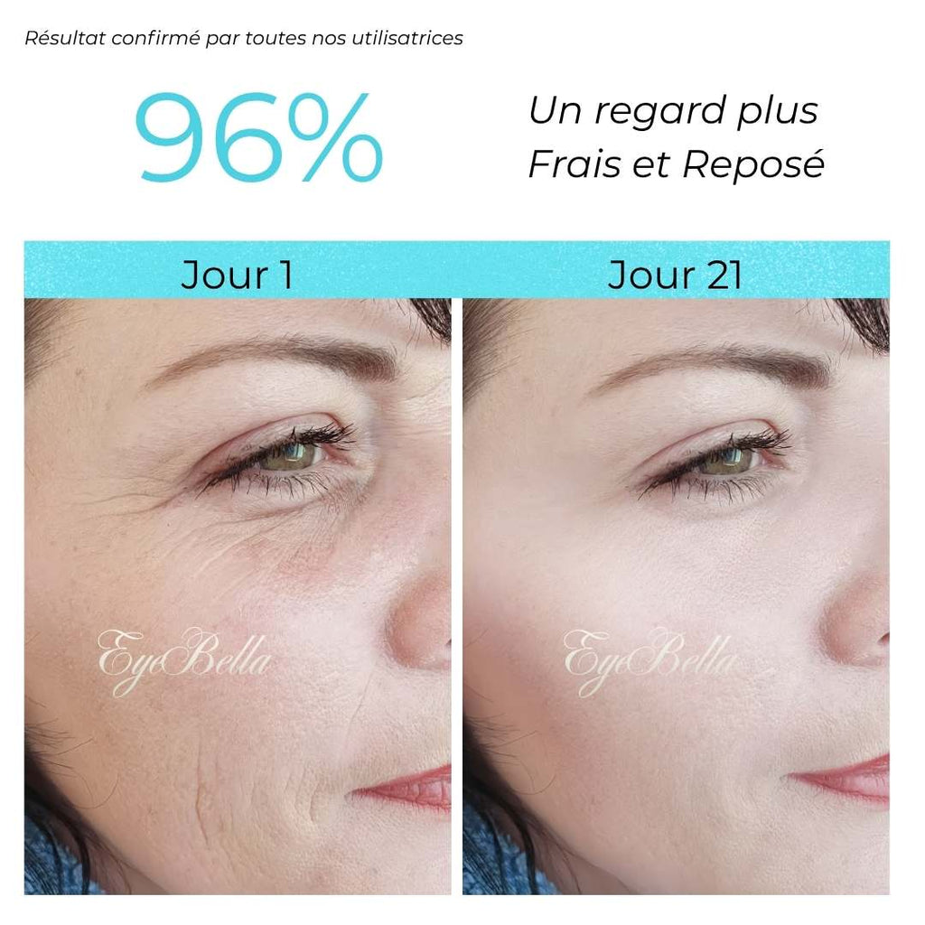 Appareil IPL pour un regard lumineux
