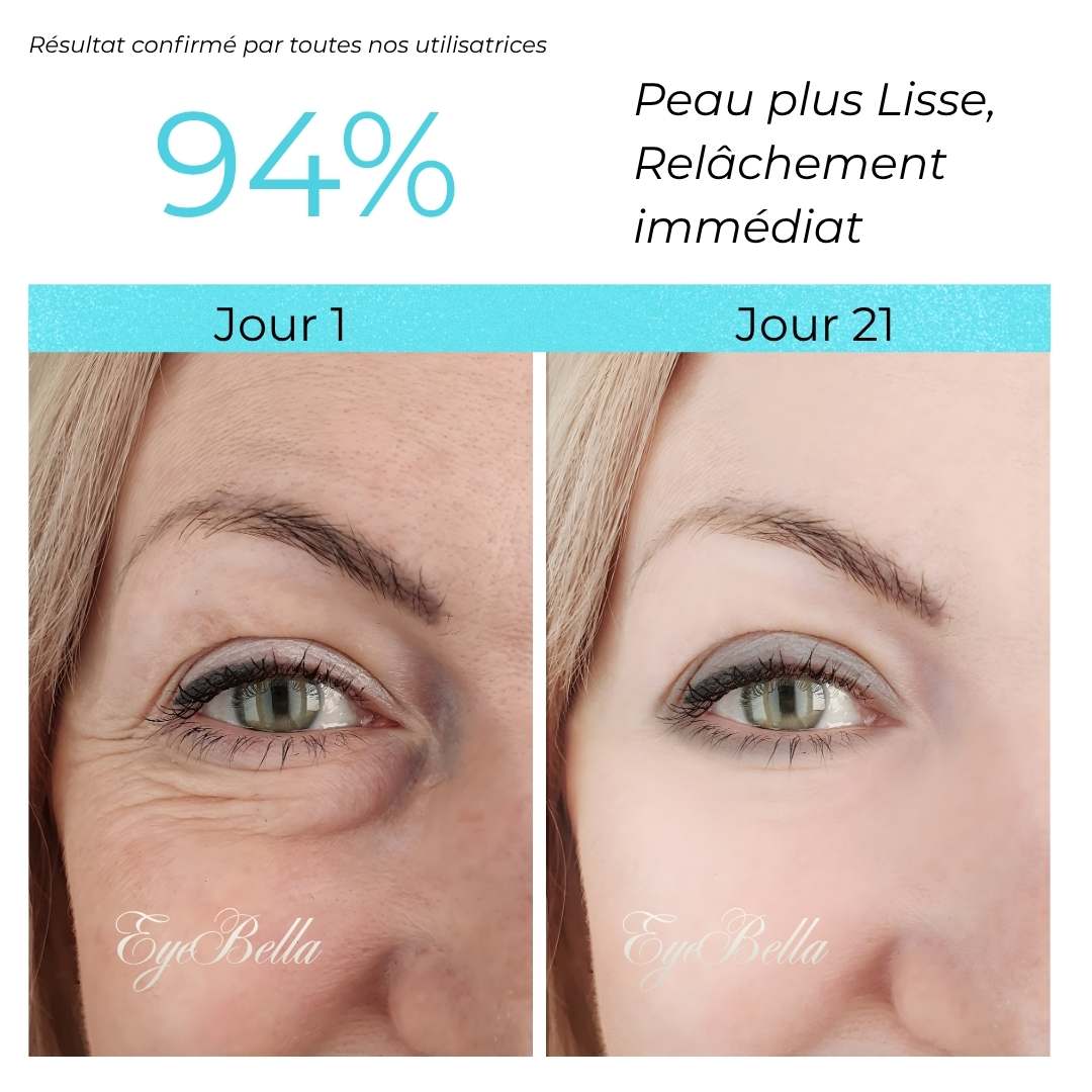 Appareil IPL pour un regard lumineux